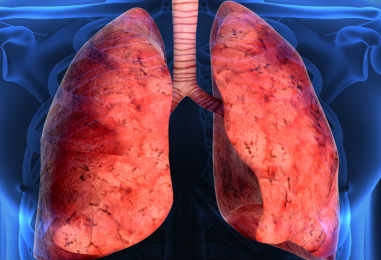 Nueva terapia que alargará la vida a pacientes de fibrosis pulmonar